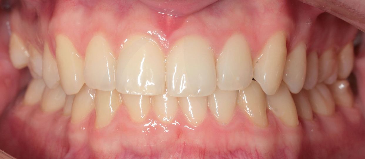 Clear aligner treatment — after