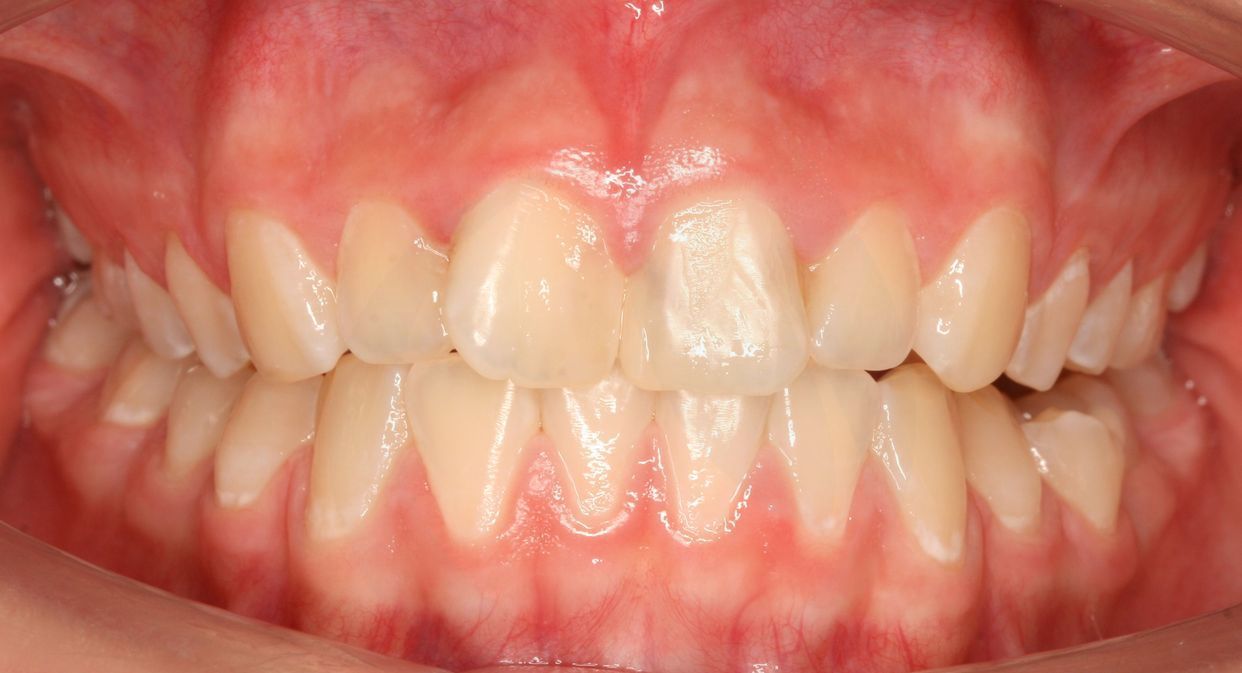 Clear aligner treatment — before