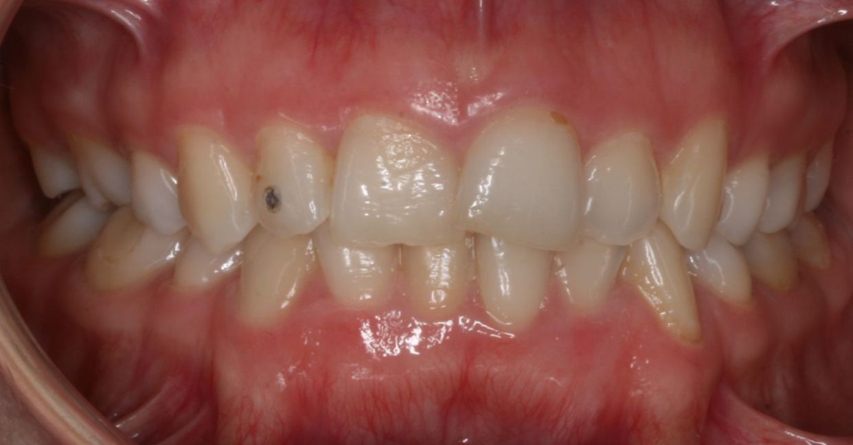 Clear aligner treatment — before