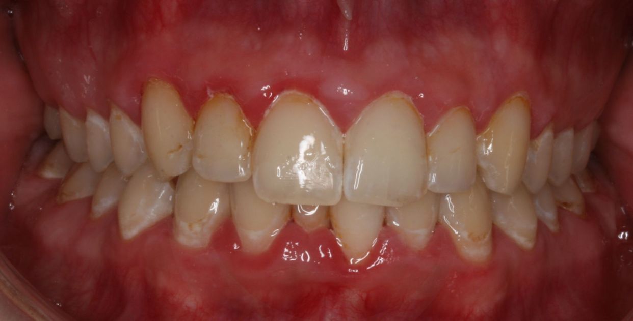 Clear aligner treatment — before