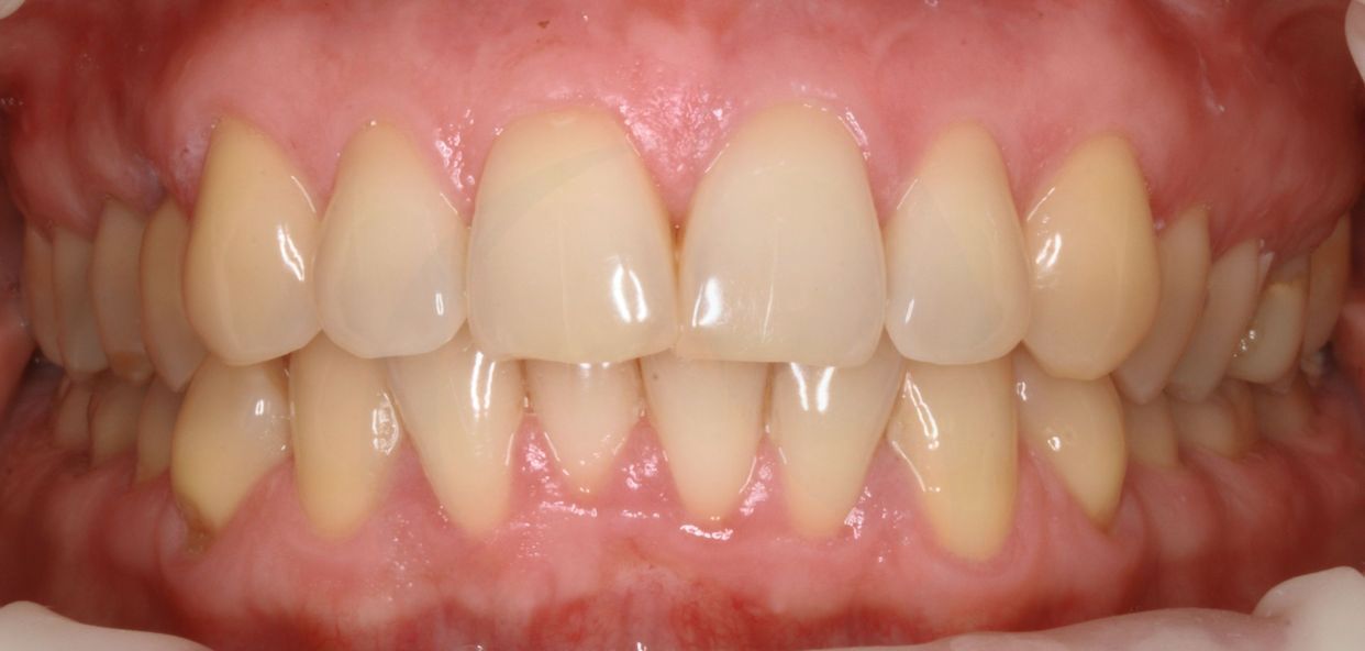 Clear aligner treatment — before