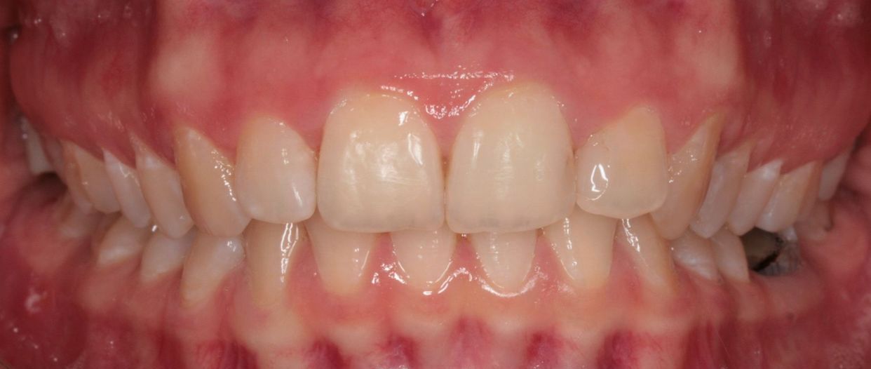 Clear aligner treatment — after