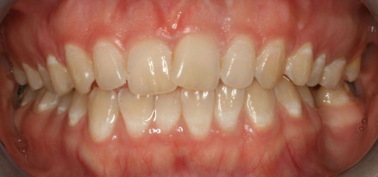 Clear aligner treatment — before