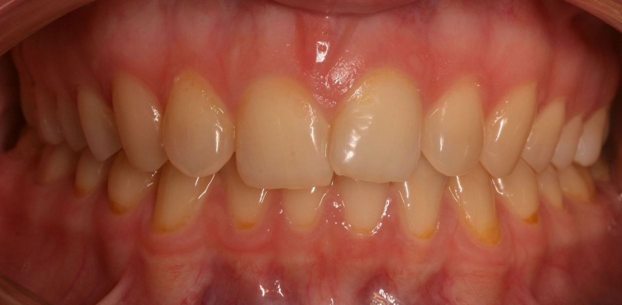 Clear aligner treatment — before