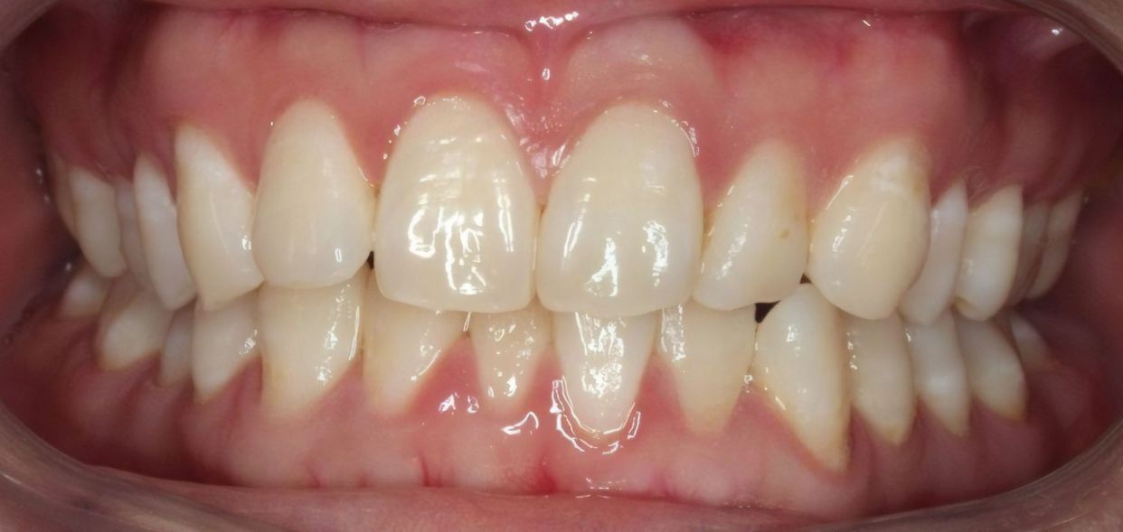 Clear aligner treatment — before