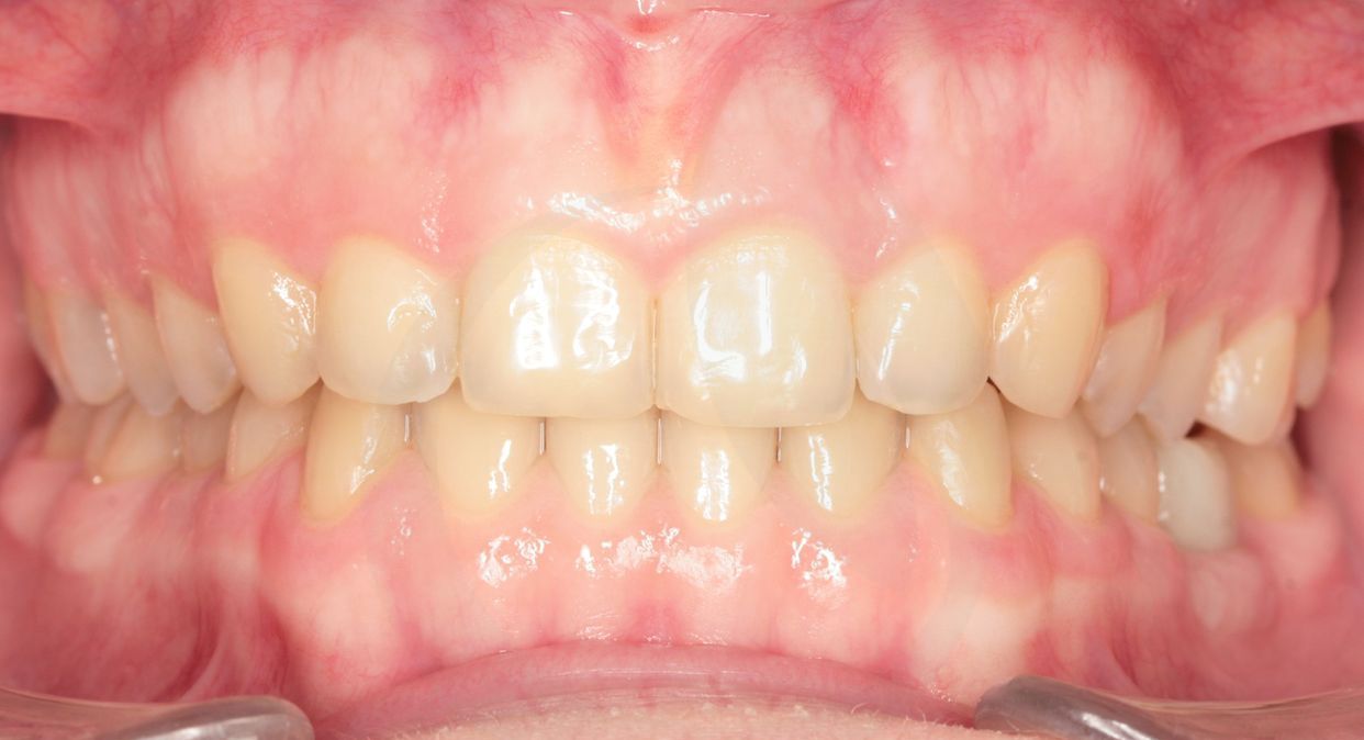 Clear aligner treatment — after