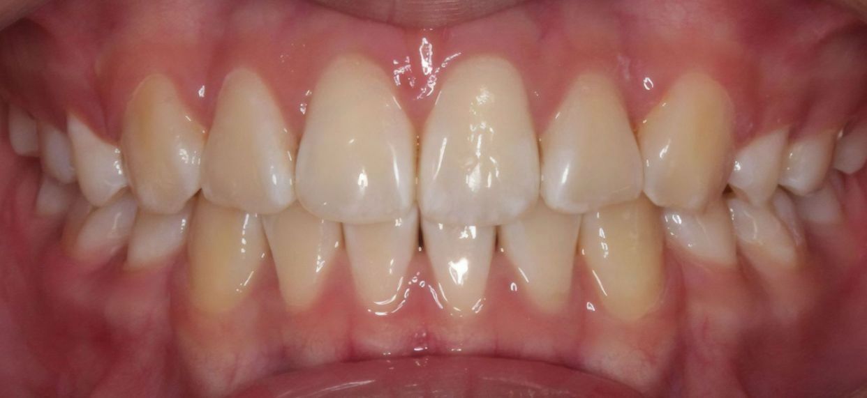 Clear aligner treatment — after