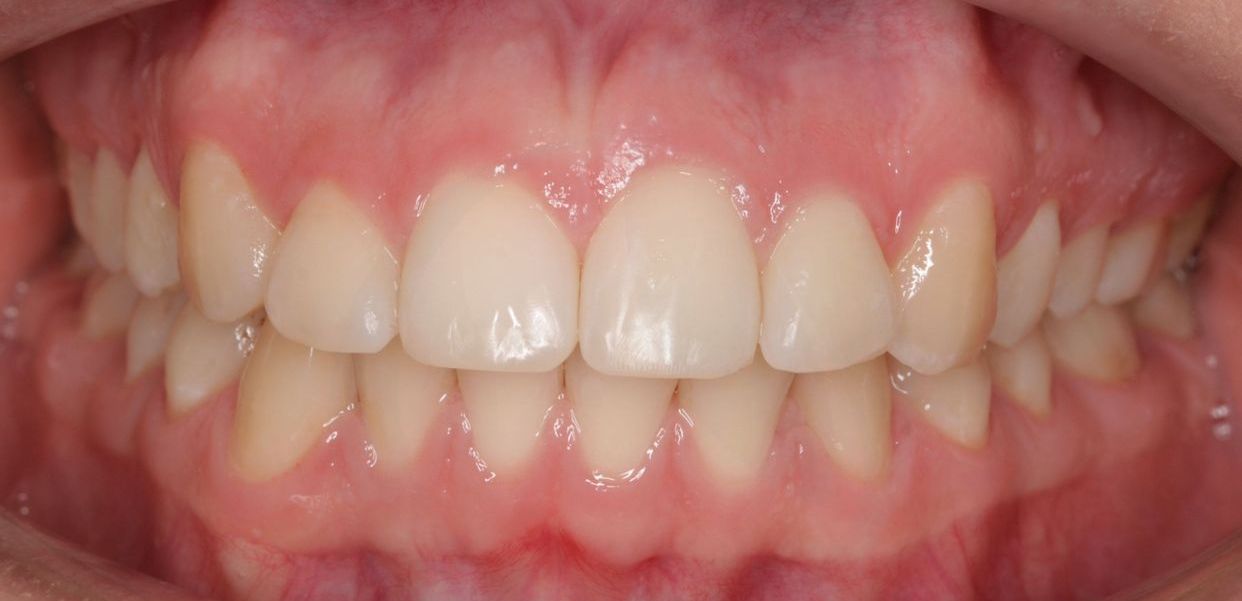 Clear aligner treatment — after