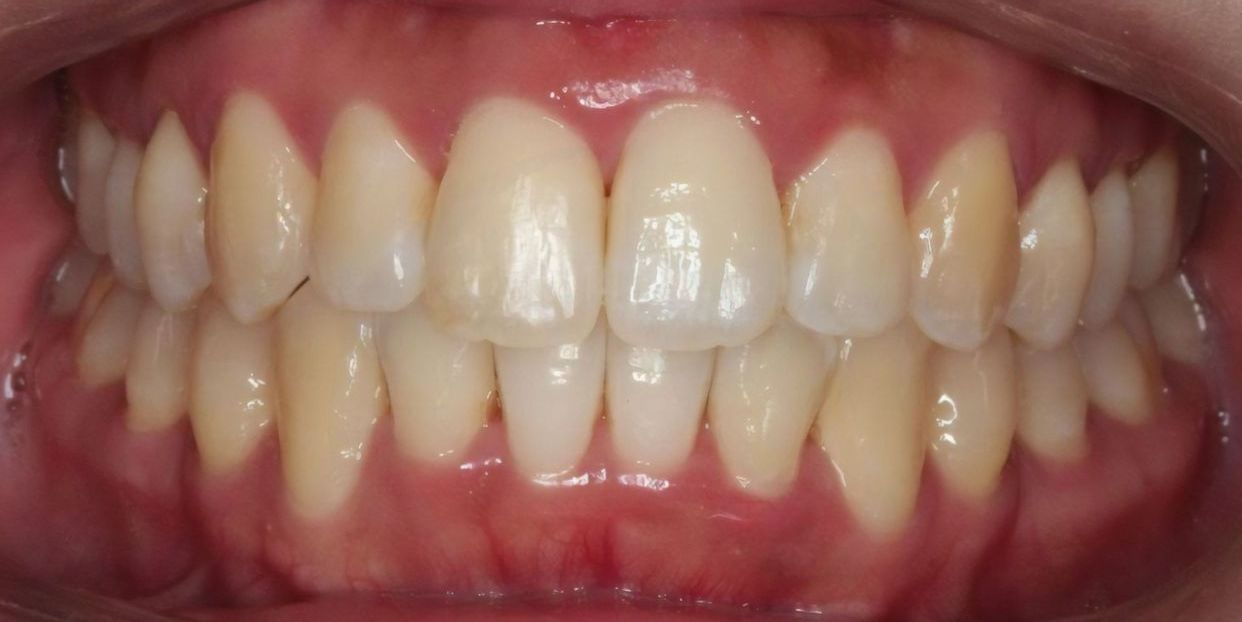 Clear aligner treatment — after