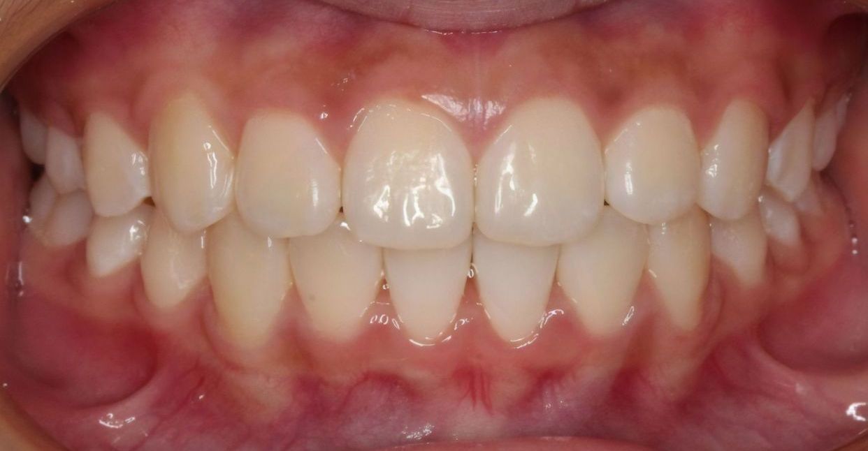 Clear aligner treatment — after