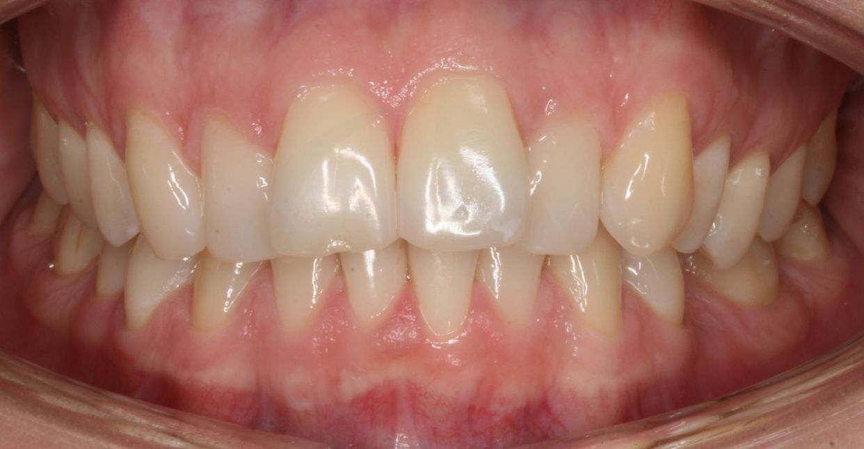 Clear aligner treatment — before