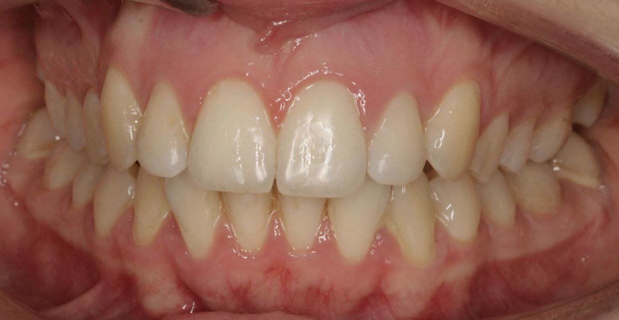Clear aligner treatment — after