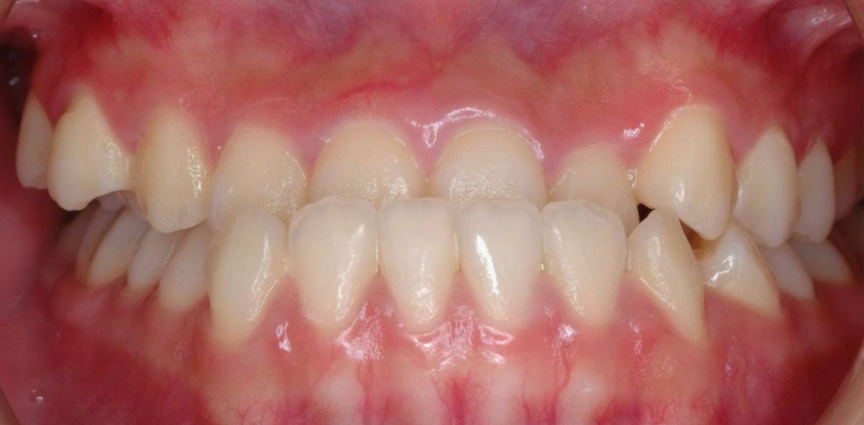 Clear aligner treatment — before