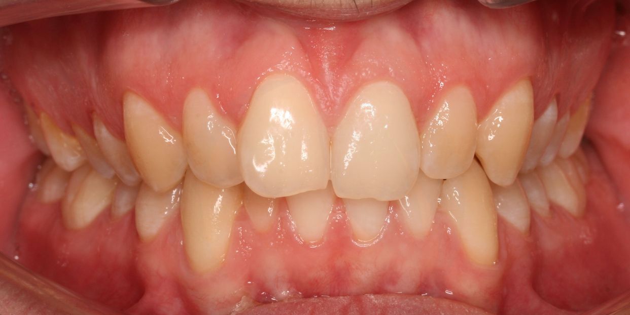 Clear aligner treatment — before