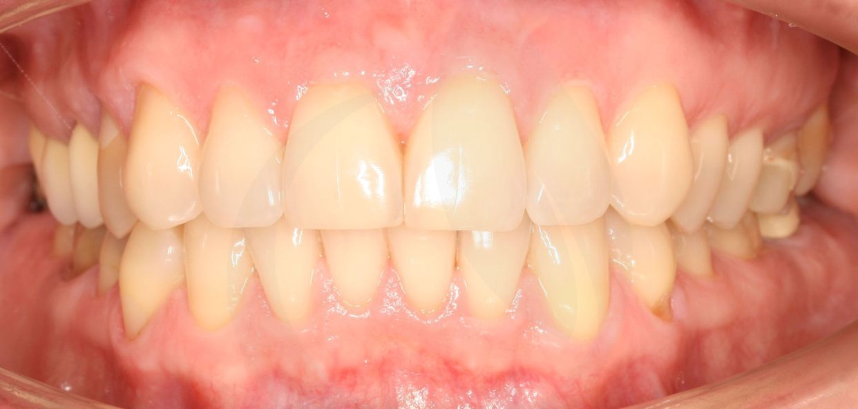 Clear aligner treatment — after