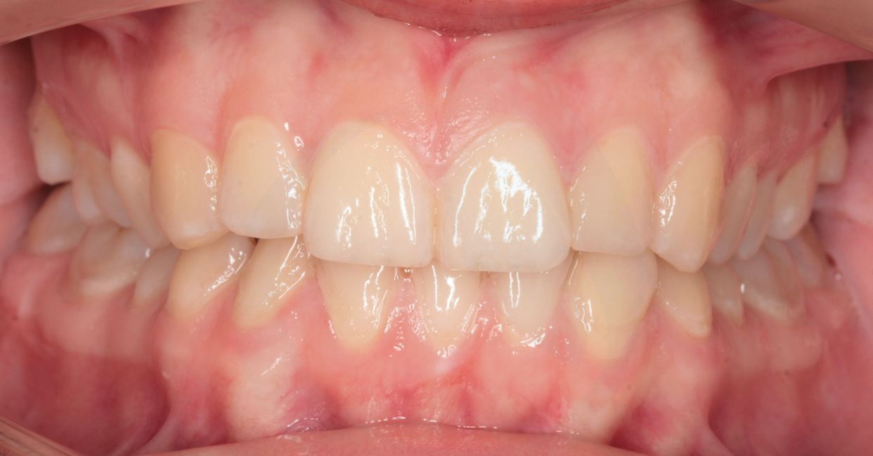 Clear aligner treatment — after
