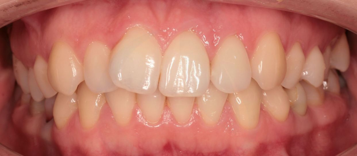 Clear aligner treatment — before
