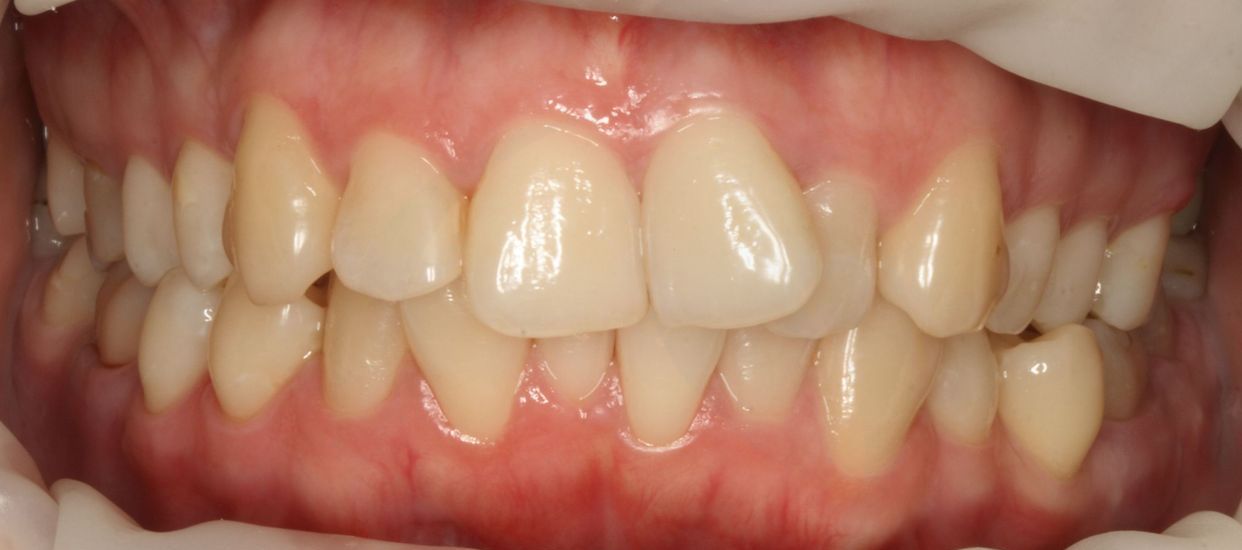 Clear aligner treatment — before