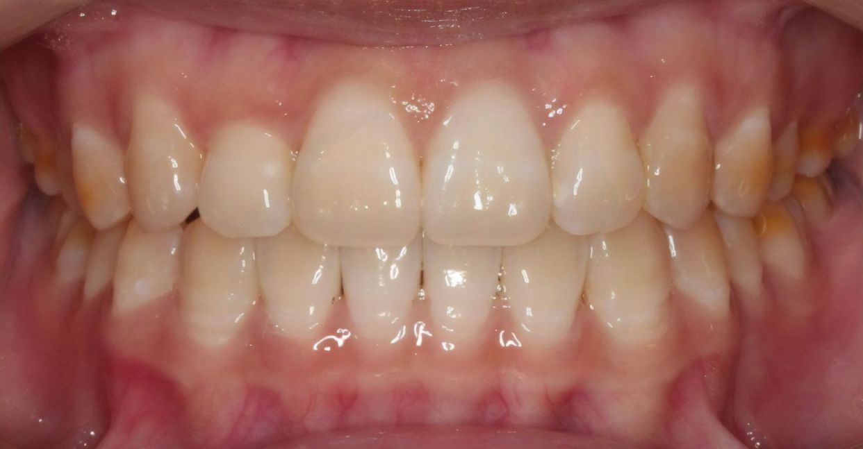 Clear aligner treatment — after
