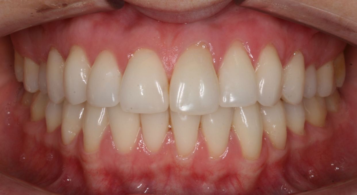 Clear aligner treatment — after