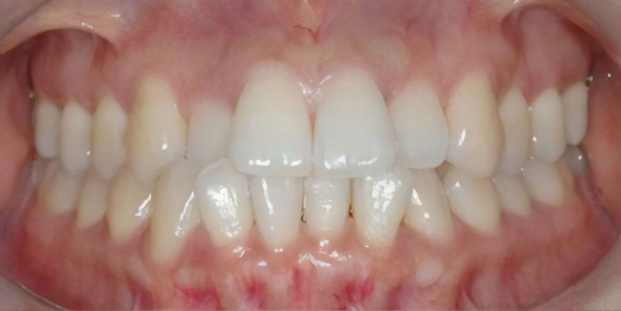 Clear aligner treatment — before