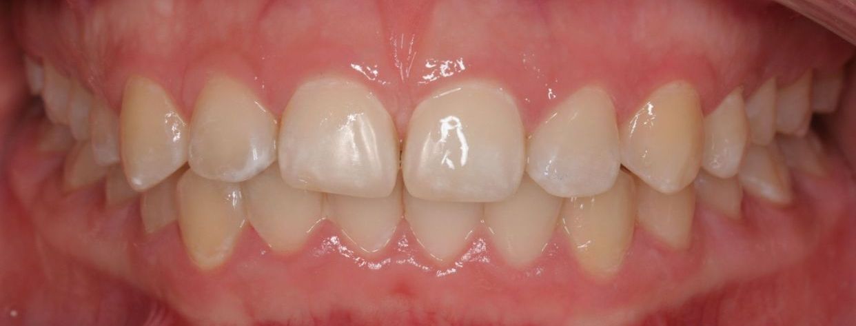 Clear aligner treatment — after