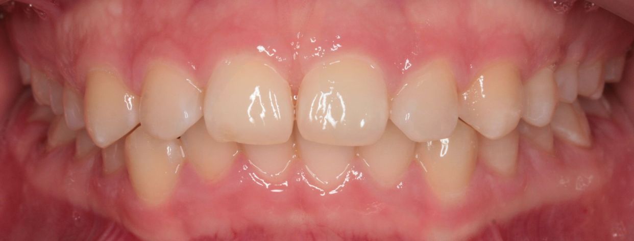 Clear aligner treatment — before