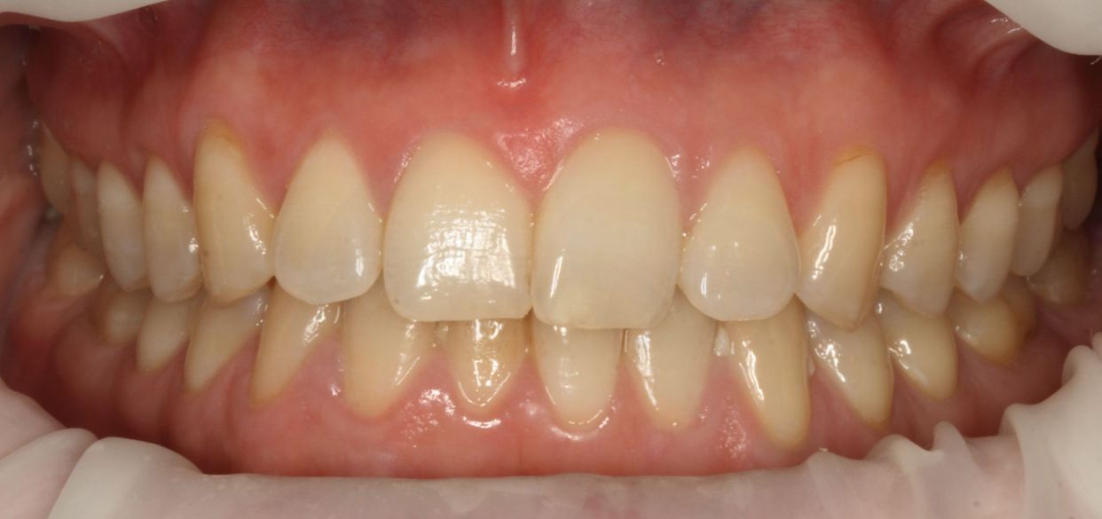 Clear aligner treatment — before