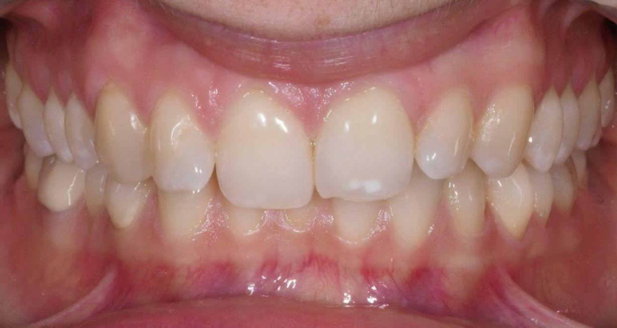 Clear aligner treatment — before