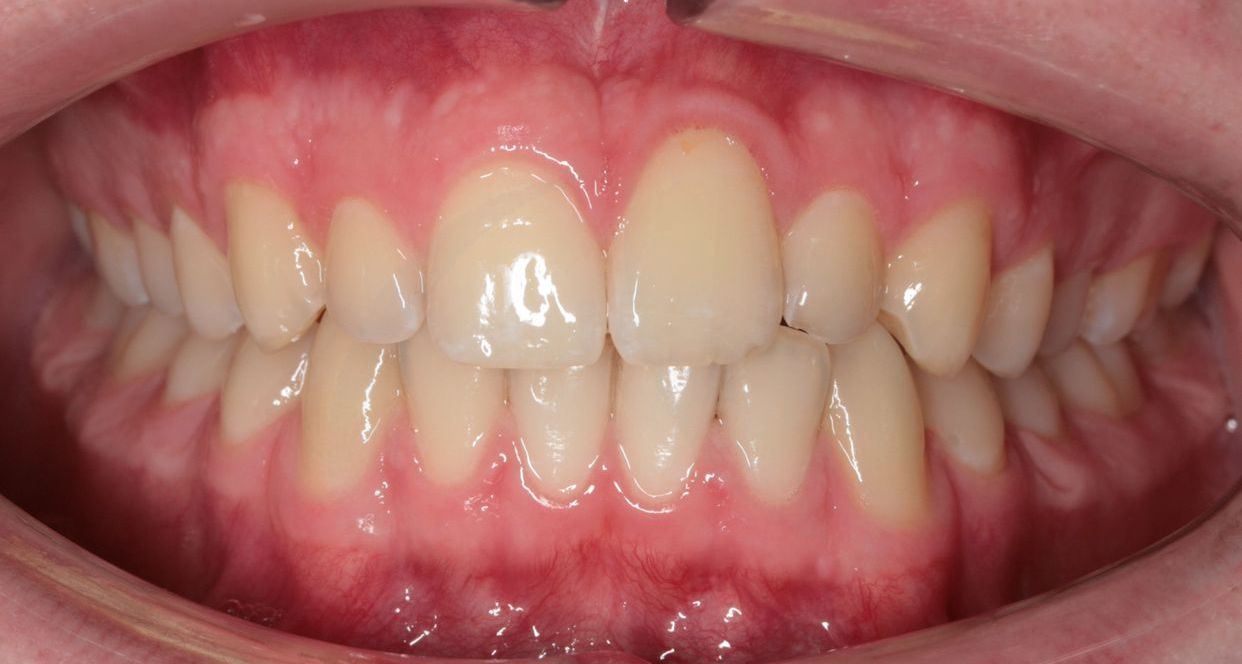 Clear aligner treatment — after