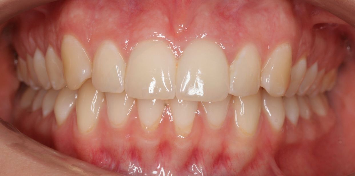 Clear aligner treatment — after