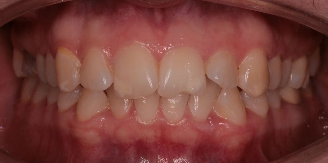 Clear aligner treatment — before