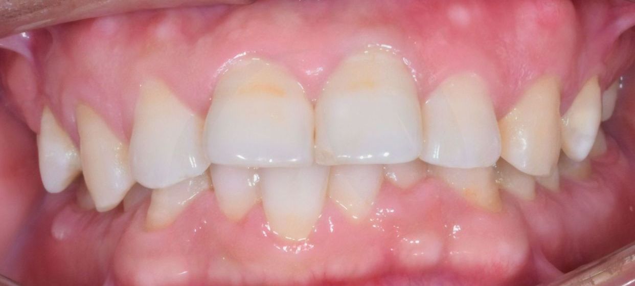Clear aligner treatment — before