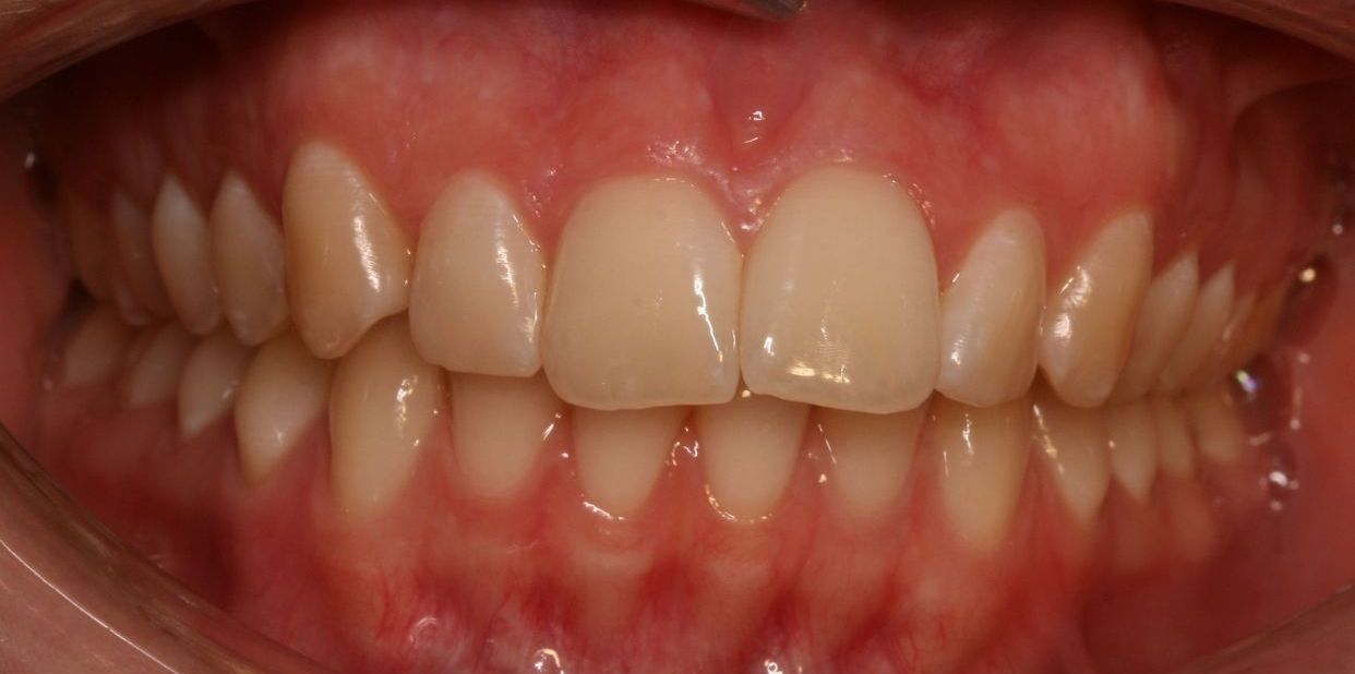 Clear aligner treatment — before