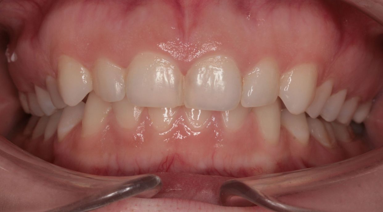 Clear aligner treatment — after