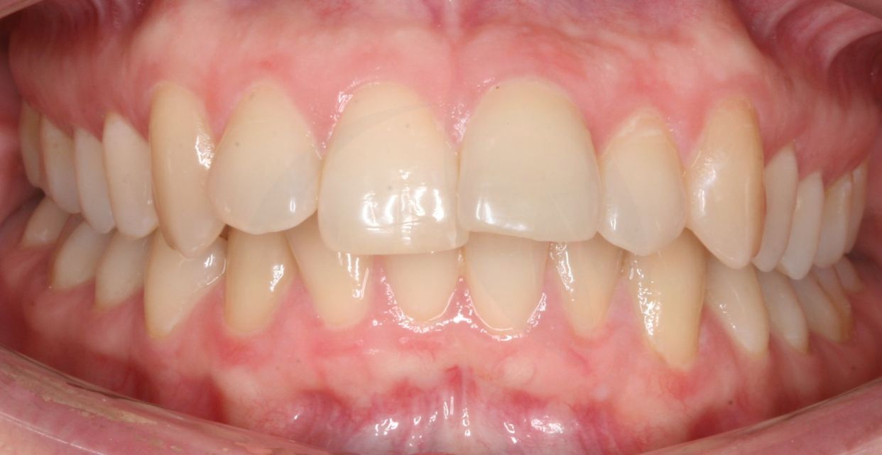 Clear aligner treatment — before