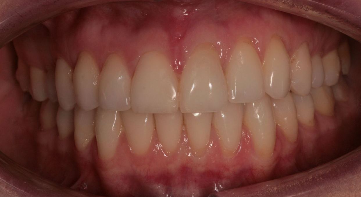 Clear aligner treatment — before