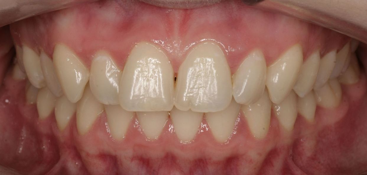 Clear aligner treatment — before
