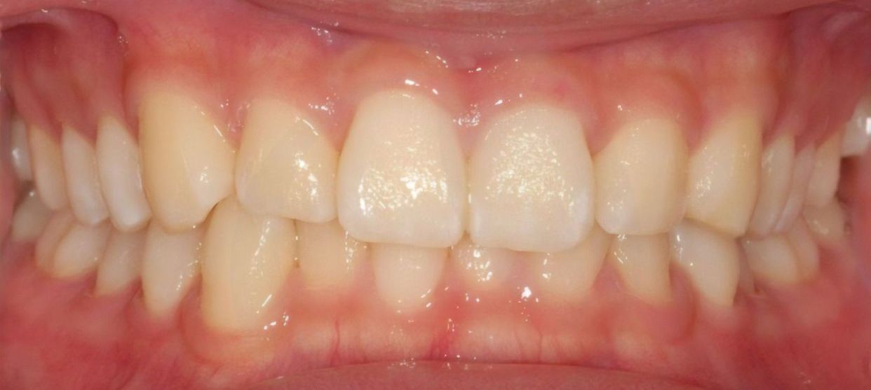 Clear aligner treatment — before