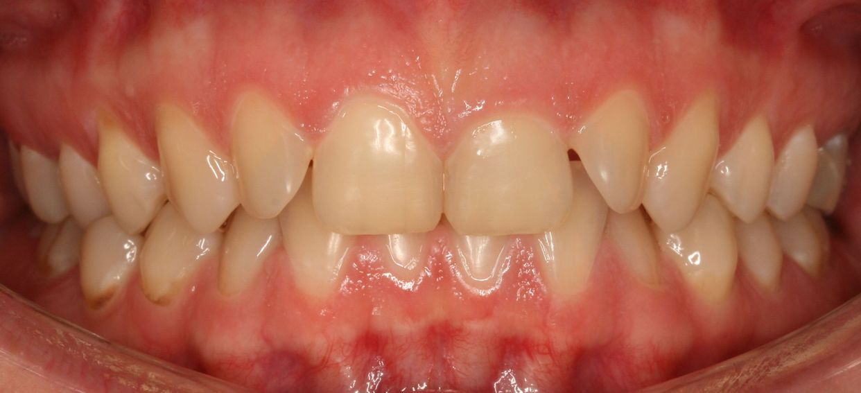 Clear aligner treatment — before