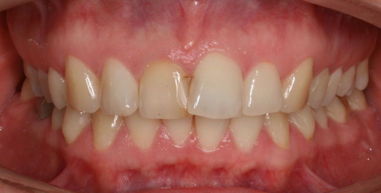 Clear aligner treatment — before