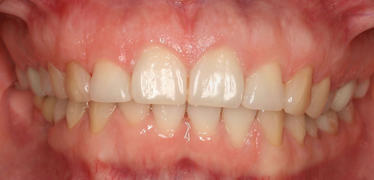 Clear aligner treatment — before