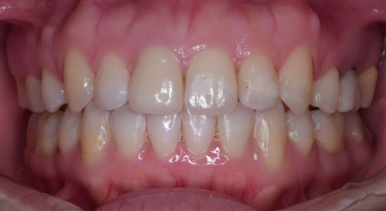 Clear aligner treatment — after