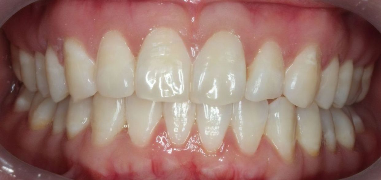 Clear aligner treatment — after