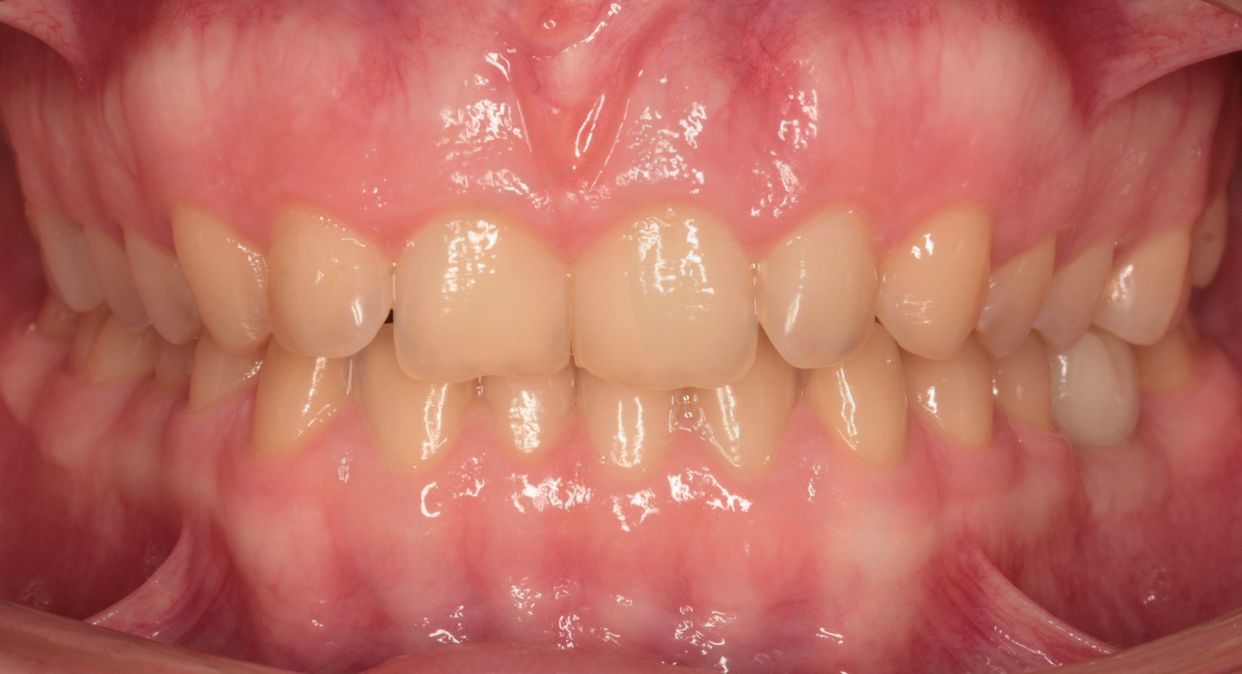 Clear aligner treatment — before