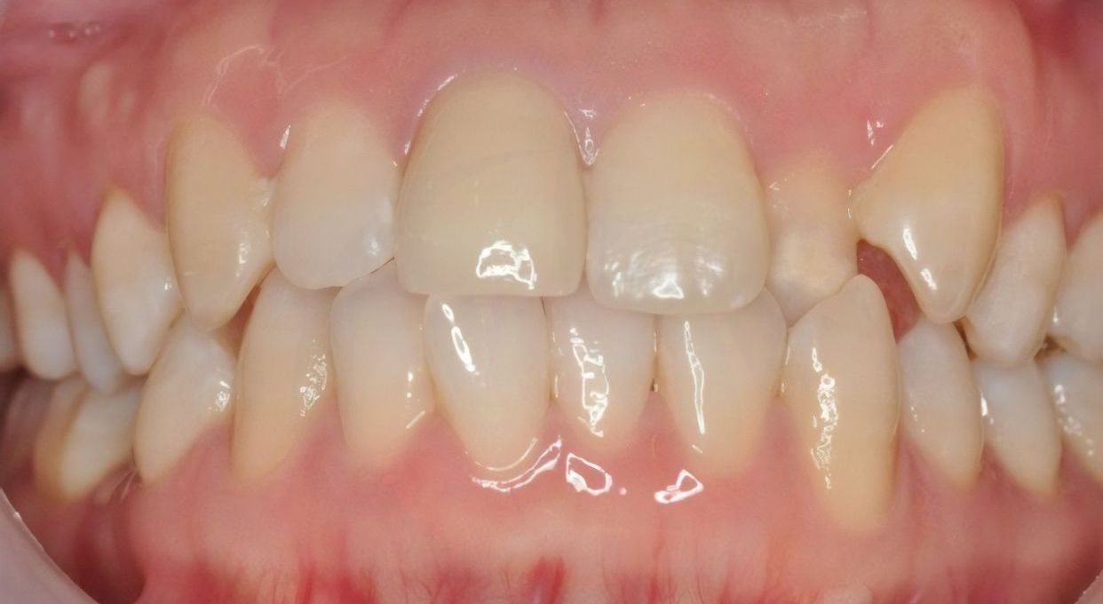 Clear aligner treatment — before