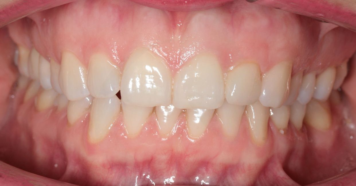 Clear aligner treatment — before