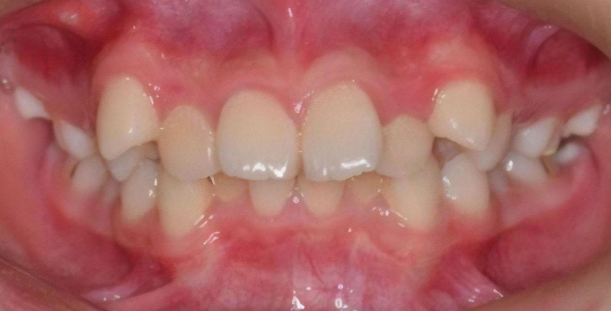Clear aligner treatment — before