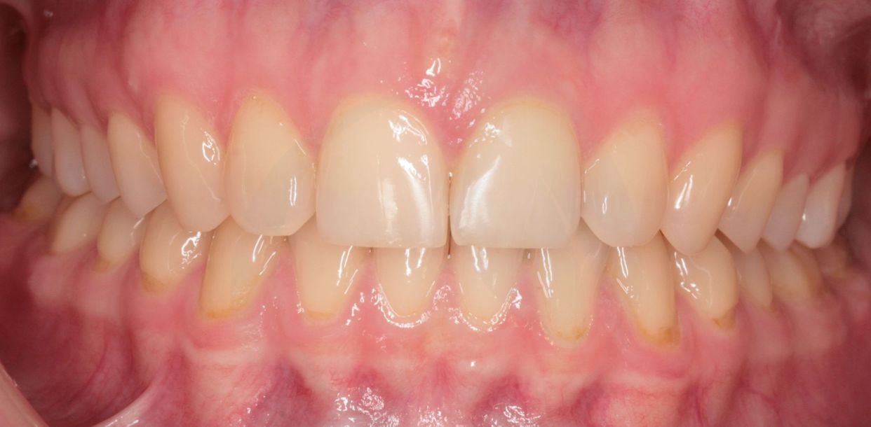 Clear aligner treatment — after
