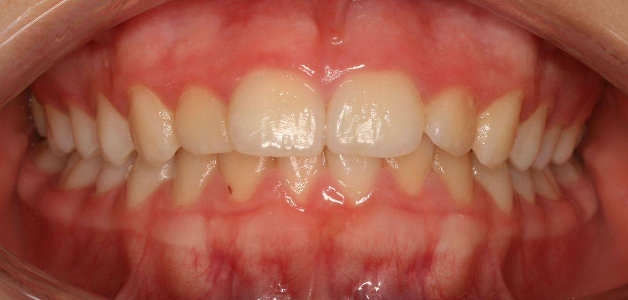 Clear aligner treatment — before